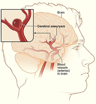 Accidente vasculare cerebrale la tineri